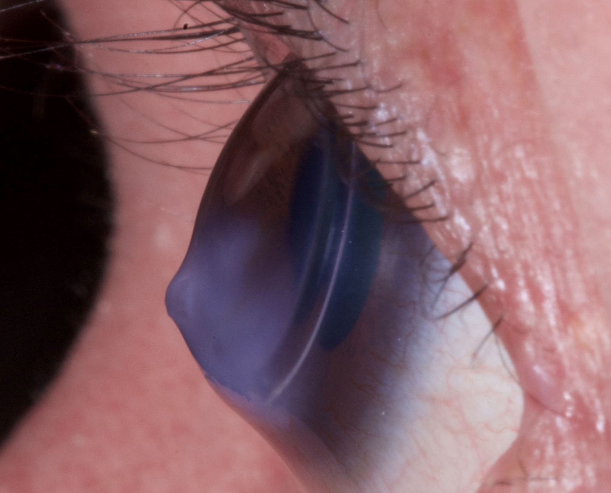 VisionTECH: Keratoconus Tech with Dr. John Gelles