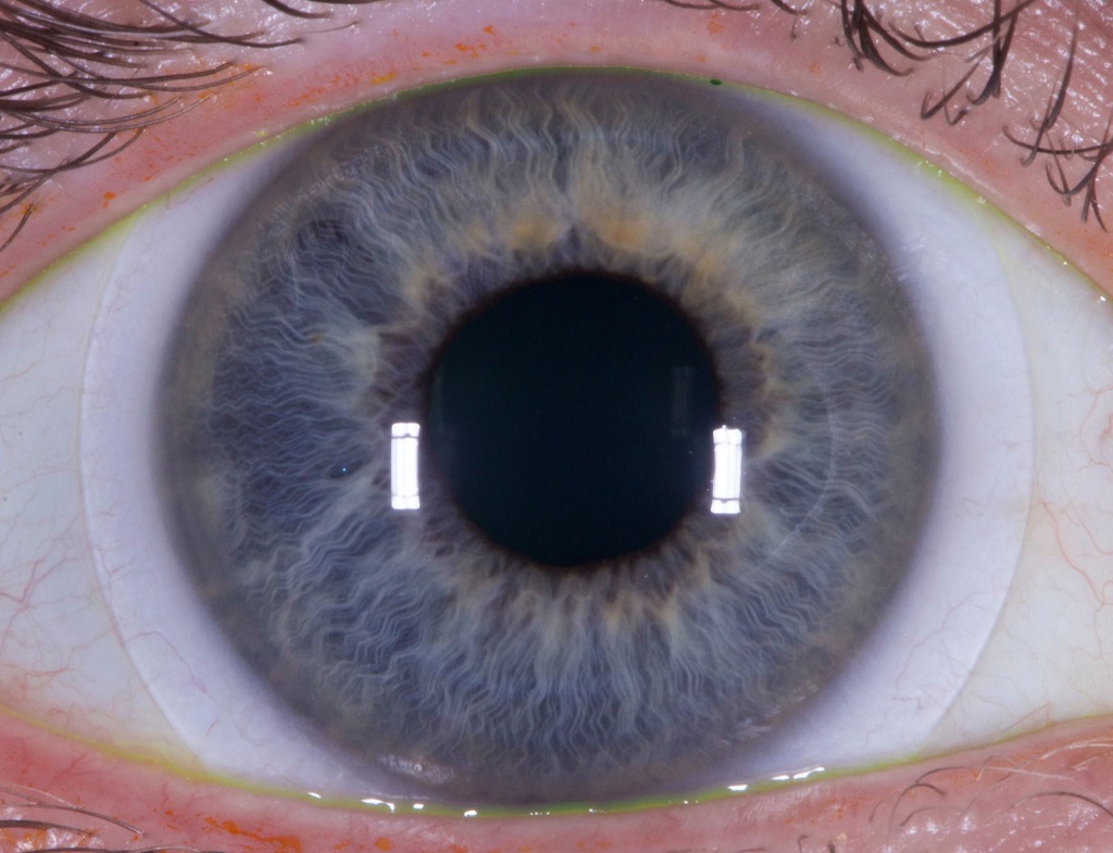 VisionTECH: Scleral Lenses with Dr. Melissa Barnett