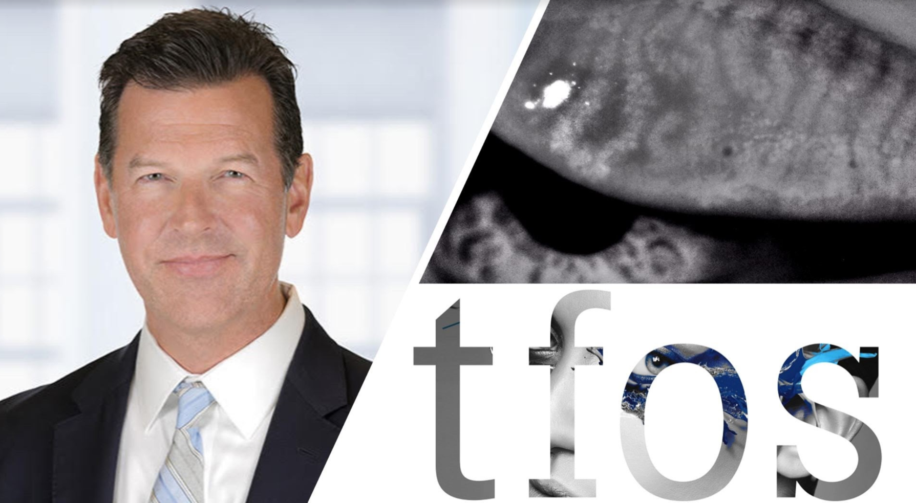 ODs on Facebook Podcast: Developing a Dry Eye Strategy with Dr. Scott Schachter Episode Feature Image