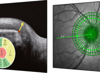Revolutionary Glaucoma Imaging: Heidelberg Engineering’s Glaucoma Module Premium Edition Revolutionary Glaucoma Imaging: Heidelberg Engineering's Glaucoma Module Premium Edition