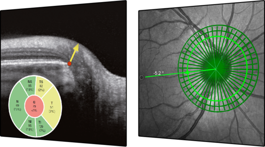 Revolutionary Glaucoma Imaging: Heidelberg Engineering's Glaucoma Module Premium Edition